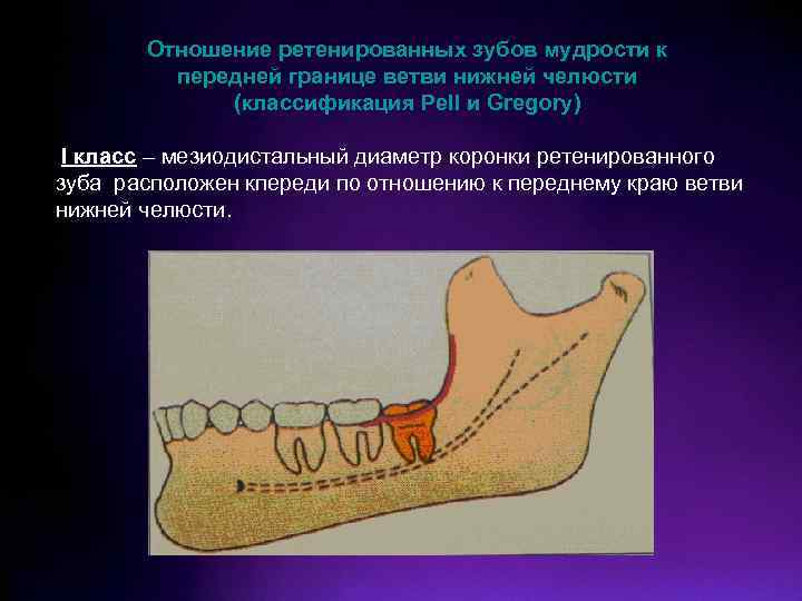 Отношение ретенированных зубов мудрости к передней границе ветви нижней челюсти (классификация Pell и Gregory)
