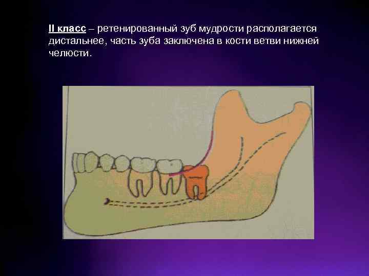 II класс – ретенированный зуб мудрости располагается дистальнее, часть зуба заключена в кости ветви