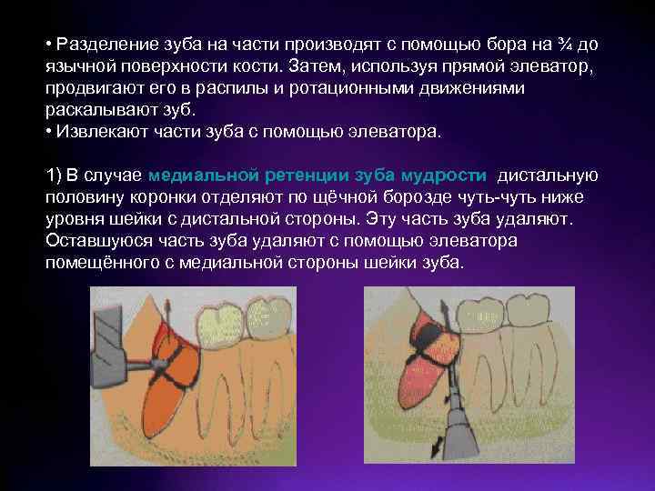  • Разделение зуба на части производят с помощью бора на ¾ до язычной