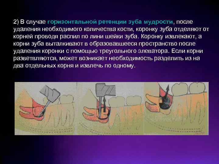 2) В случае горизонтальной ретенции зуба мудрости, после удаления необходимого количества кости, коронку зуба