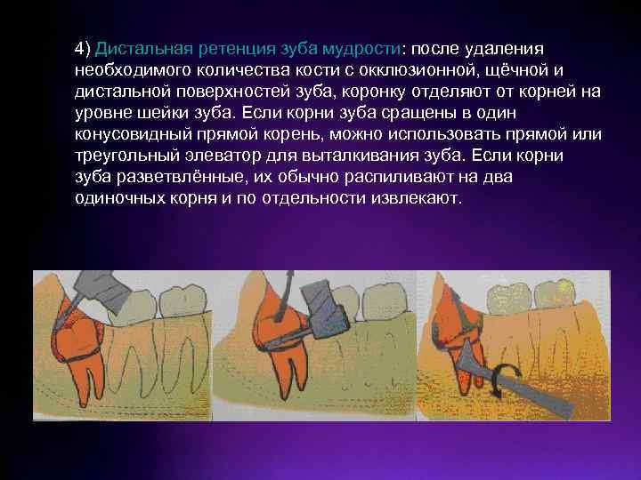 4) Дистальная ретенция зуба мудрости: после удаления необходимого количества кости с окклюзионной, щёчной и