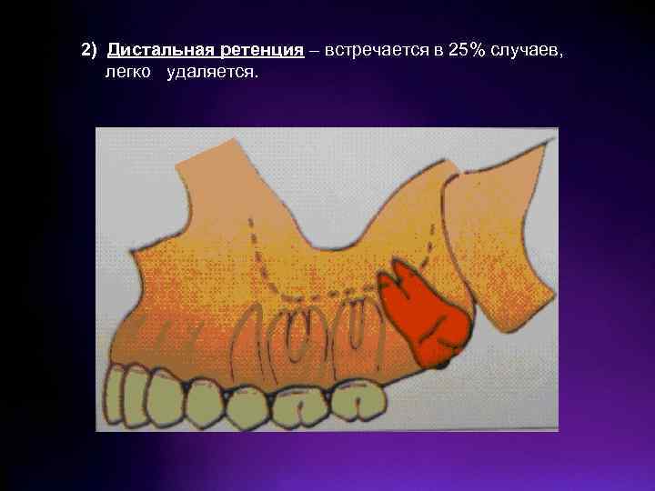 Болезни прорезывания зубов презентация