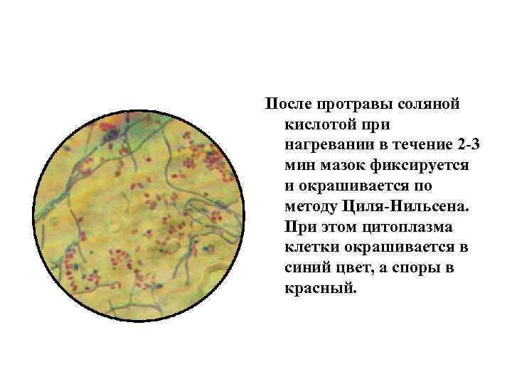 После протравы соляной кислотой при нагревании в течение 2 -3 мин мазок фиксируется и