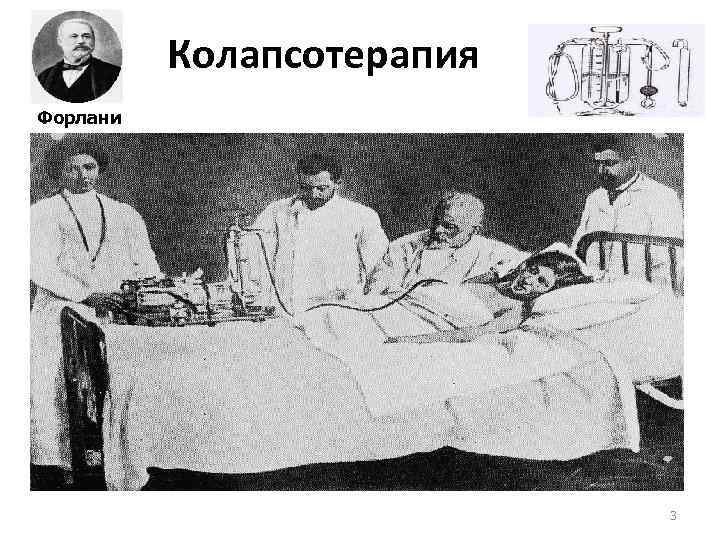 Колапсотерапия Форлани 3 