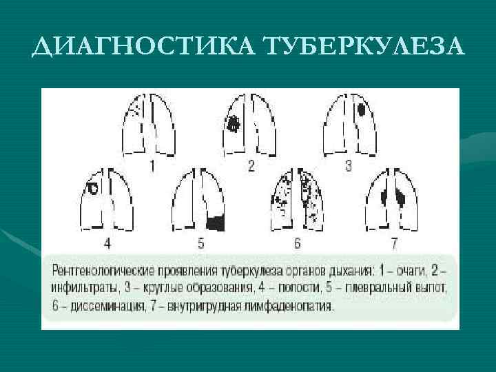 ДИАГНОСТИКА ТУБЕРКУЛЕЗА 