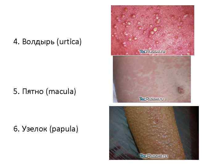 4. Волдырь (urtica) 5. Пятно (macula) 6. Узелок (papula) 