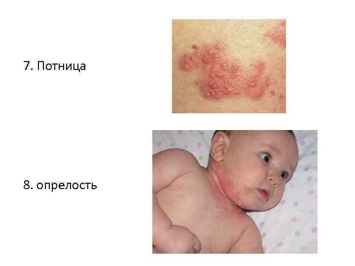 7. Потница 8. опрелость 