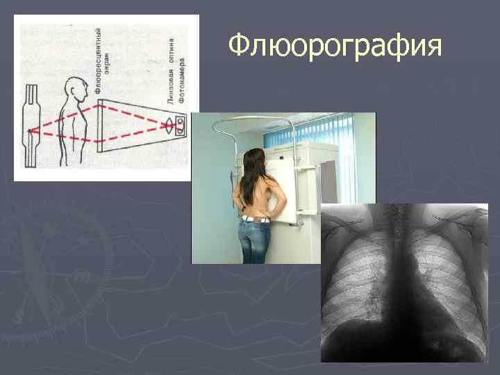  Флюорография 