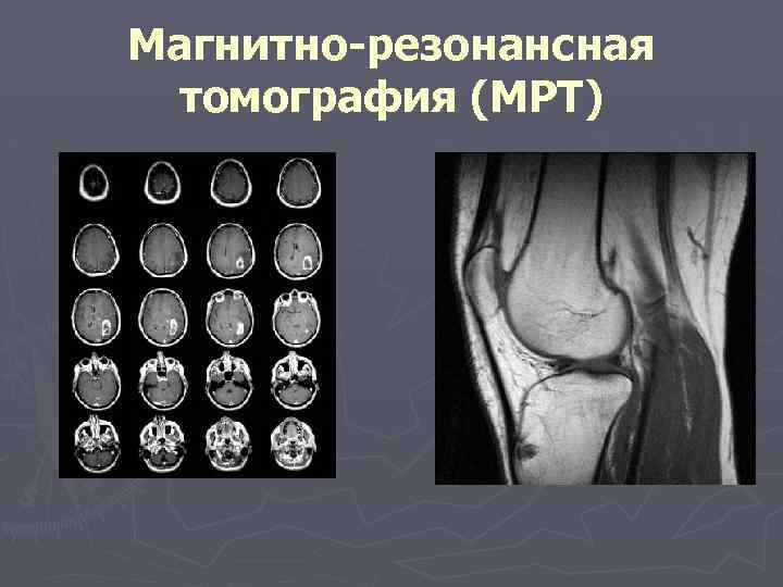 Магнитно резонансная томография (МРТ) 