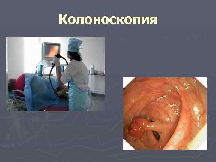 Колоноскопия 