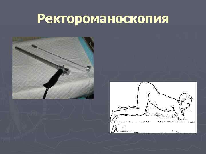 Ректороманоскопия 