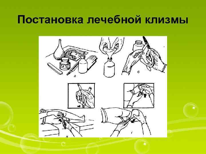 Постановка лечебной клизмы 