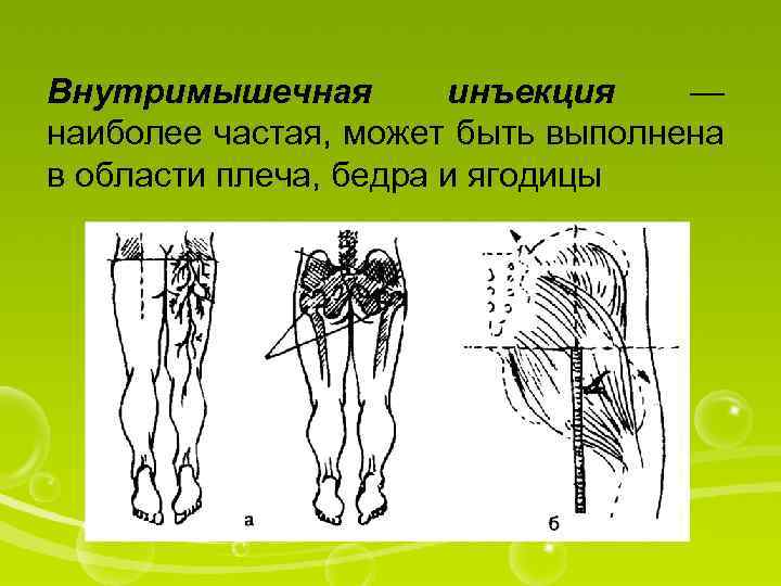 Внутримышечная инъекция — наиболее частая, может быть выполнена в области плеча, бедра и ягодицы