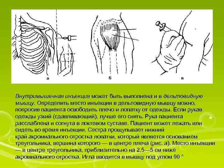 Внутримышечная инъекция презентация