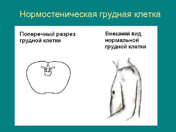 Нормостеническая грудная клетка 