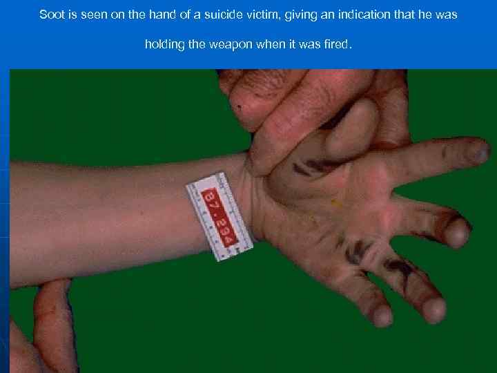 Soot is seen on the hand of a suicide victim, giving an indication that
