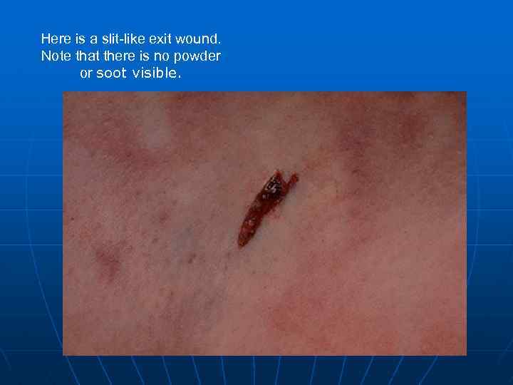 Here is a slit-like exit wound. Note that there is no powder or soot