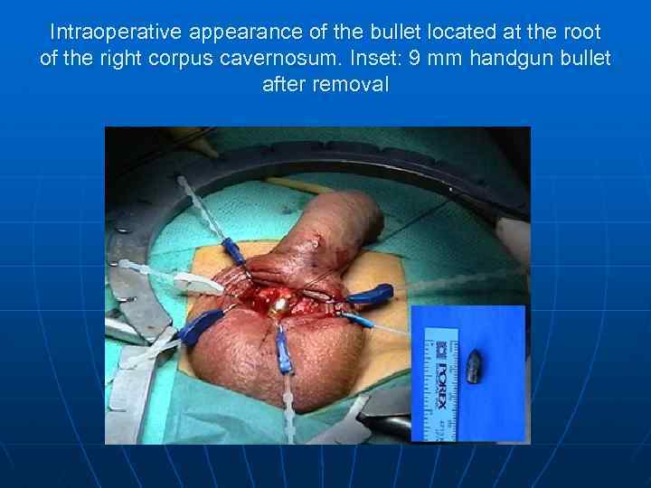 Intraoperative appearance of the bullet located at the root of the right corpus cavernosum.