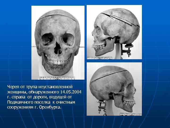 Череп от трупа неустановленной женщины, обнаруженного 14. 05. 2004 г. справа от дороги, ведущей