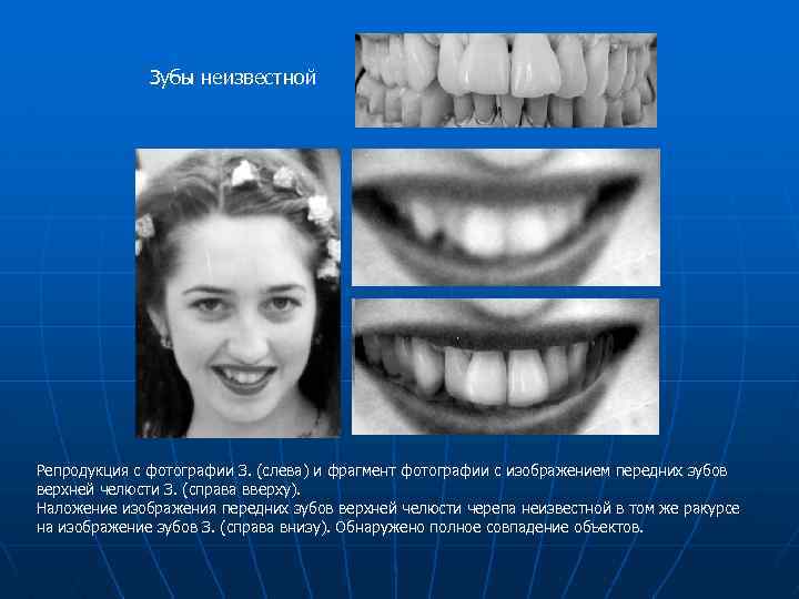 Зубы неизвестной Репродукция с фотографии З. (слева) и фрагмент фотографии с изображением передних зубов