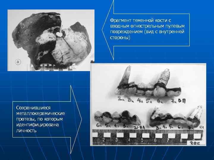 Фрагмент теменной кости с входным огнестрельным пулевым повреждением (вид с внутренней стороны) Сохранившиеся металлокерамические
