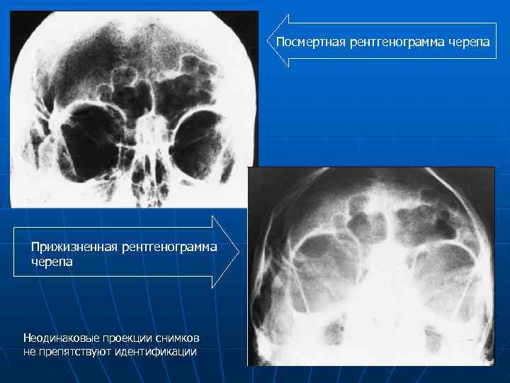 Посмертная рентгенограмма черепа Прижизненная рентгенограмма черепа Неодинаковые проекции снимков не препятствуют идентификации 