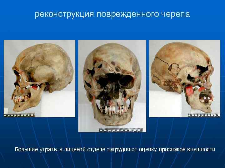 реконструкция поврежденного черепа Большие утраты в лицевой отделе затрудняют оценку признаков внешности 