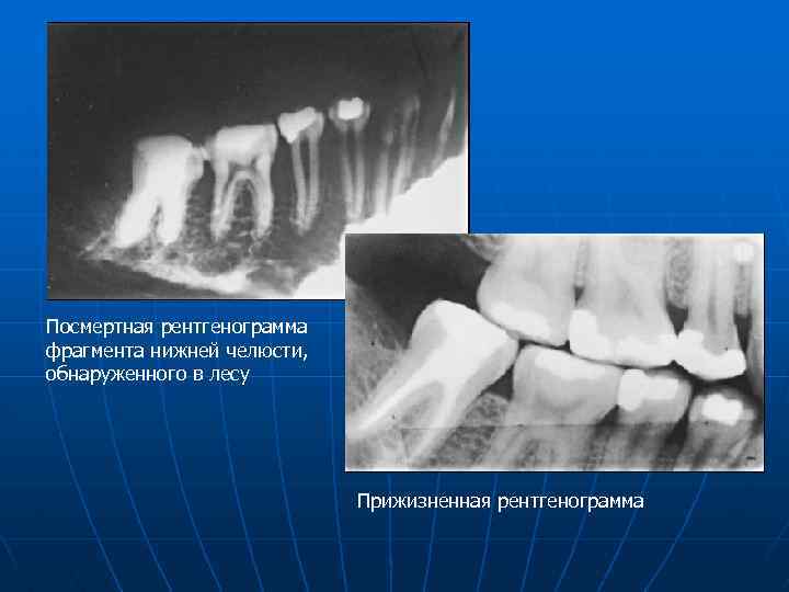Посмертная рентгенограмма фрагмента нижней челюсти, обнаруженного в лесу Прижизненная рентгенограмма 