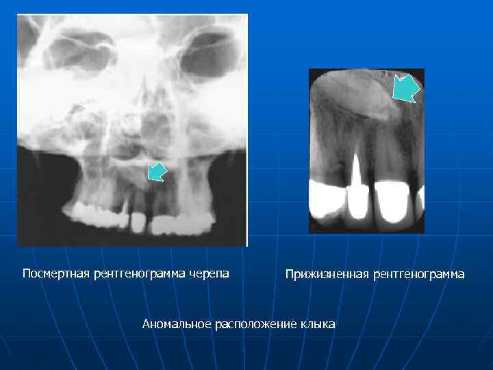 Посмертная рентгенограмма черепа Прижизненная рентгенограмма Аномальное расположение клыка 