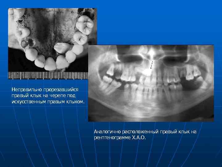 Неправильно прорезавшийся правый клык на черепе под искусственным правым клыком. Аналогично расположенный правый клык