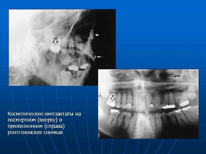 Косметические имплантаты на посмертном (вверху) и прижизненном (справа) рентгеновских снимках 