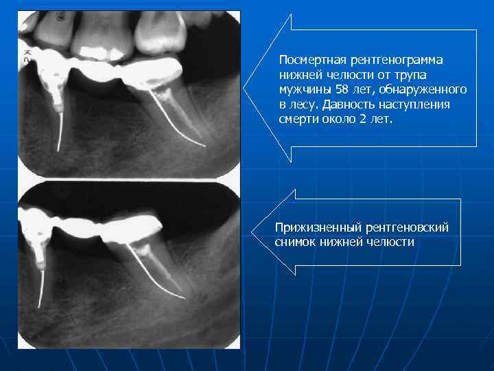 Посмертная рентгенограмма нижней челюсти от трупа мужчины 58 лет, обнаруженного в лесу. Давность наступления