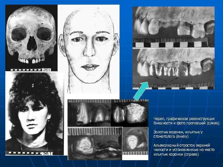 Череп, графическая реконструкция Внешности и фото пропавшей (слева). Золотые коронки, изъятые у стоматолога (внизу)