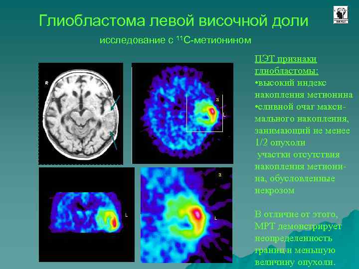 Глиобластома левой височной доли исследование с 11 С-метионином a a ПЭТ признаки глиобластомы: •