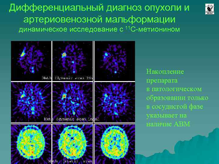 Дифференциальный диагноз опухоли и артериовенозной мальформации динамическое исследование с 11 C-метионином Накопление препарата в