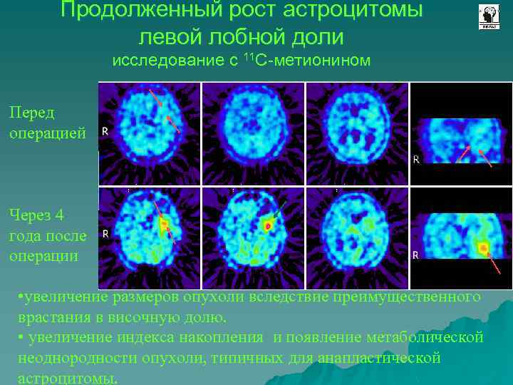 Продолженный рост астроцитомы левой лобной доли исследование с 11 С-метионином Перед операцией Через 4