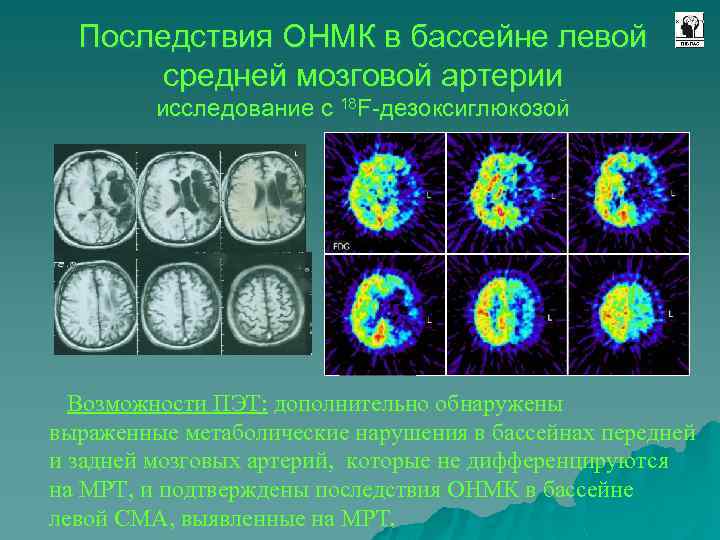Последствия ОНМК в бассейне левой средней мозговой артерии исследование с 18 F-дезоксиглюкозой Возможности ПЭТ: