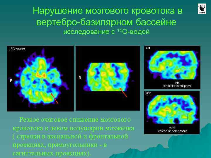 Нарушение мозгового кровотока в вертебро-базилярном бассейне исследование с 15 О-водой Резкое очаговое снижение мозгового