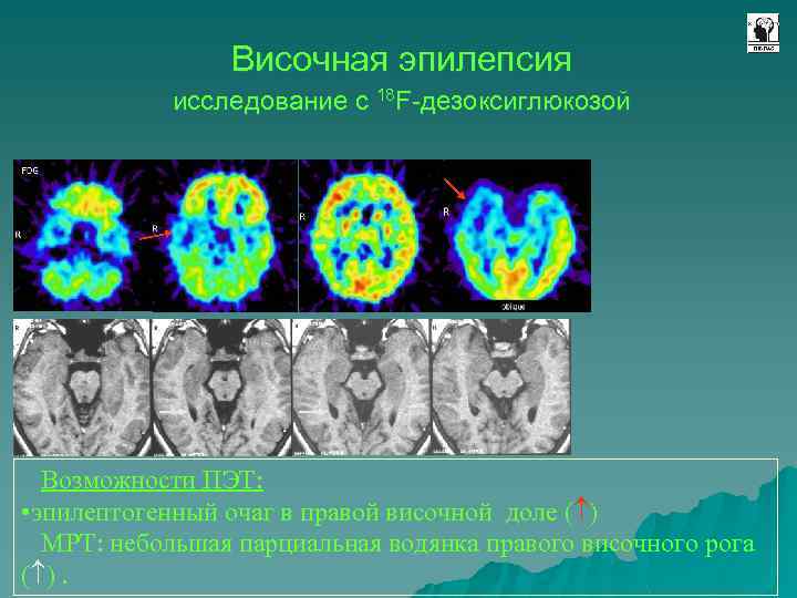 Височная эпилепсия исследование с 18 F-дезоксиглюкозой Возможности ПЭТ: • эпилептогенный очаг в правой височной