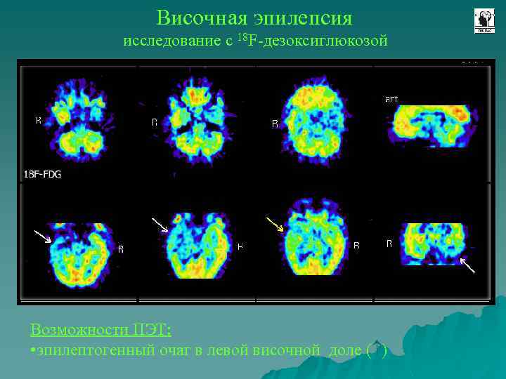 Височная эпилепсия исследование с 18 F-дезоксиглюкозой Возможности ПЭТ: • эпилептогенный очаг в левой височной