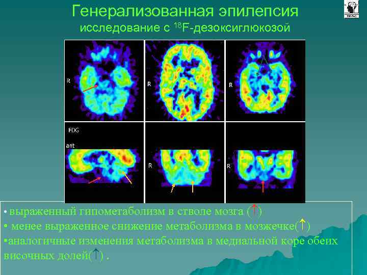 Генерализованная эпилепсия исследование с 18 F-дезоксиглюкозой • выраженный гипометаболизм в стволе мозга ( )