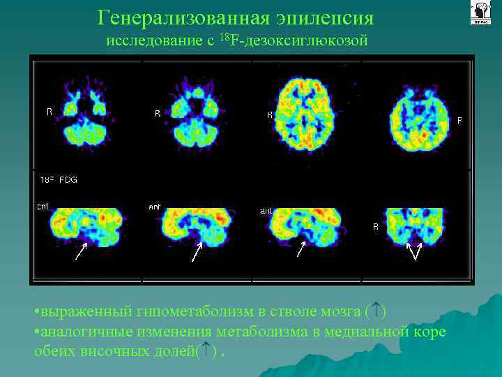 Генерализованная эпилепсия исследование с 18 F-дезоксиглюкозой • выраженный гипометаболизм в стволе мозга ( )