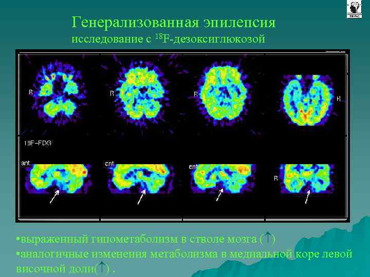 Генерализованная эпилепсия исследование с 18 F-дезоксиглюкозой • выраженный гипометаболизм в стволе мозга ( )