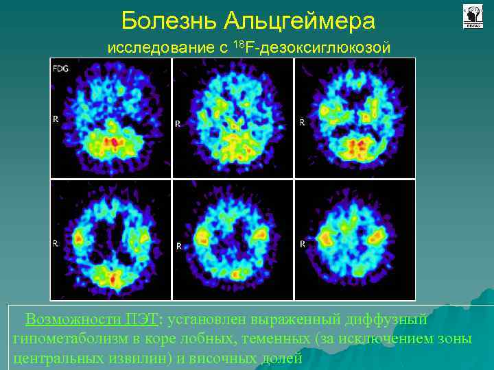 Болезнь Альцгеймера исследование с 18 F-дезоксиглюкозой Возможности ПЭТ: установлен выраженный диффузный гипометаболизм в коре