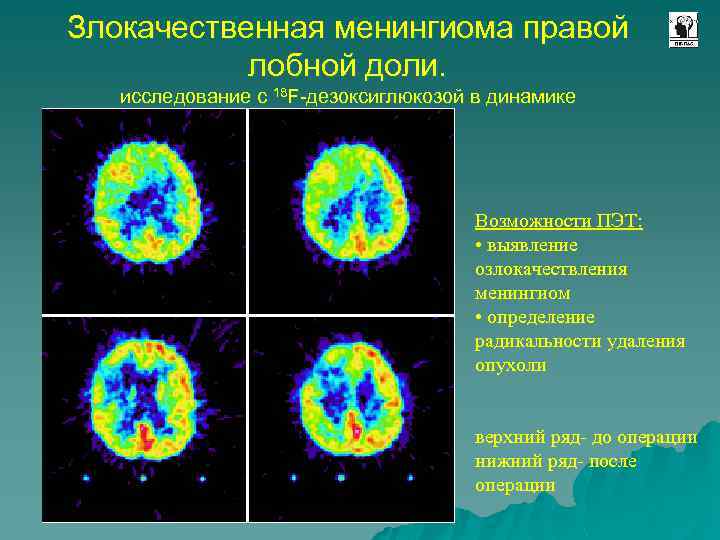 Злокачественная менингиома правой лобной доли. исследование с 18 F-дезоксиглюкозой в динамике Возможности ПЭТ: •