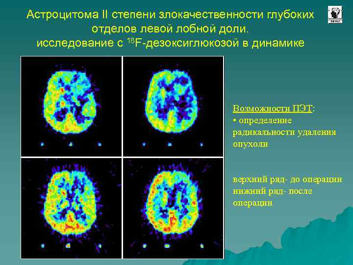 Астроцитома II степени злокачественности глубоких отделов левой лобной доли. исследование с 18 F-дезоксиглюкозой в