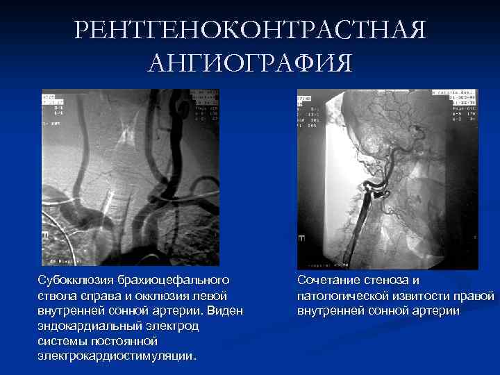 РЕНТГЕНОКОНТРАСТНАЯ АНГИОГРАФИЯ Субокклюзия брахиоцефального ствола справа и окклюзия левой внутренней сонной артерии. Виден эндокардиальный