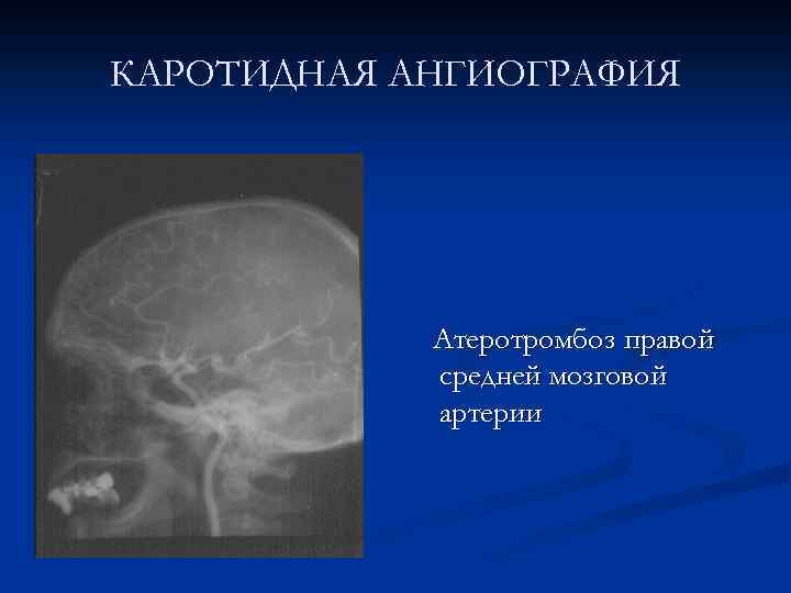 КАРОТИДНАЯ АНГИОГРАФИЯ Атеротромбоз правой средней мозговой артерии 