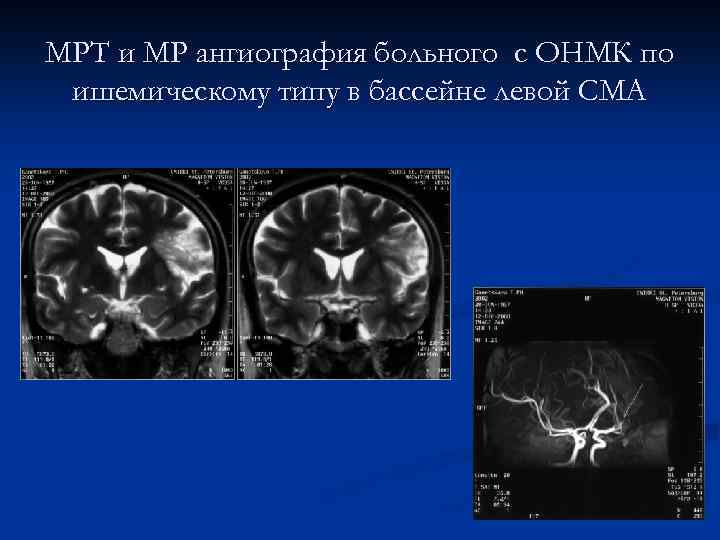 МРТ и МР ангиография больного с ОНМК по ишемическому типу в бассейне левой СМА