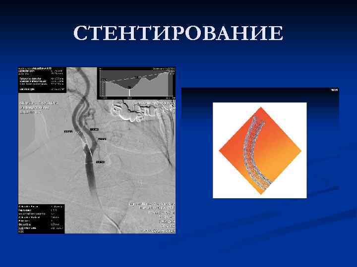 СТЕНТИРОВАНИЕ 